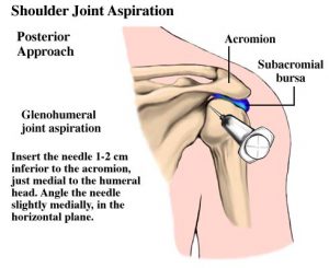 block-shoulderasp_posterior