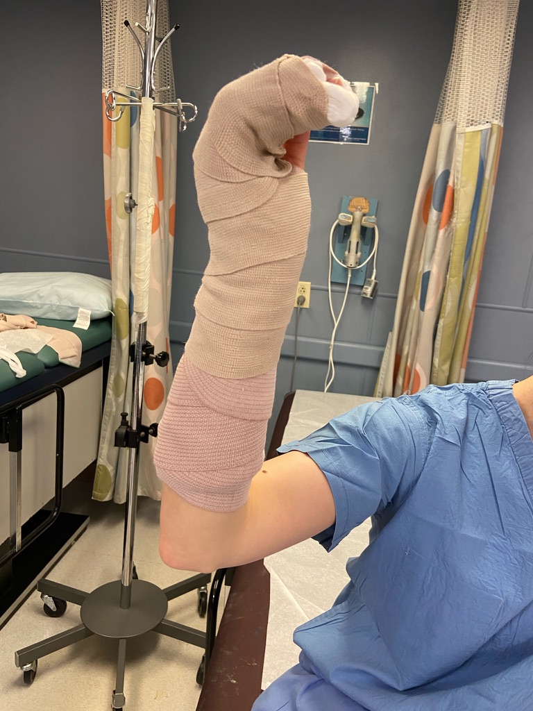 splint-ulnargutter_complete+ACE